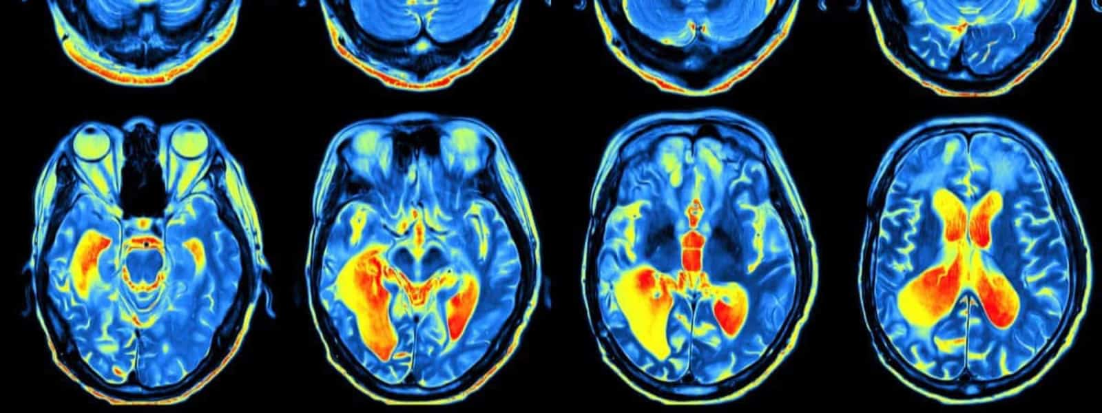 A series of brain scans