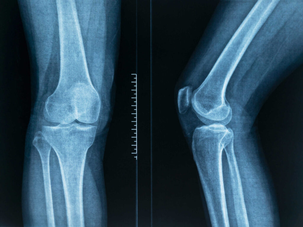 Radiography of a young male arm humerus on top